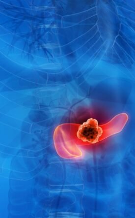 Medical illustration of a human torso highlighting a tumor in the pancreas in the abdomen.