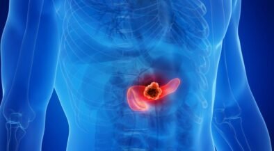 Medical illustration of a human torso highlighting a tumor in the pancreas in the abdomen.