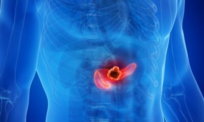Medical illustration of a human torso highlighting a tumor in the pancreas in the abdomen.
