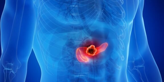 Medical illustration of a human torso highlighting a tumor in the pancreas in the abdomen.