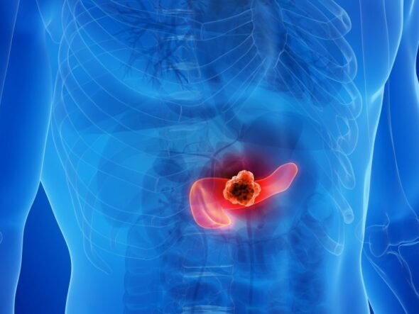 Medical illustration of a human torso highlighting a tumor in the pancreas in the abdomen.