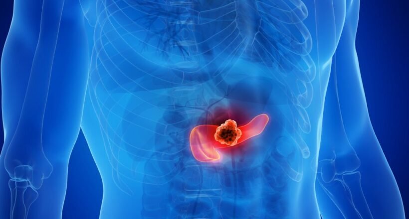 Medical illustration of a human torso highlighting a tumor in the pancreas in the abdomen.